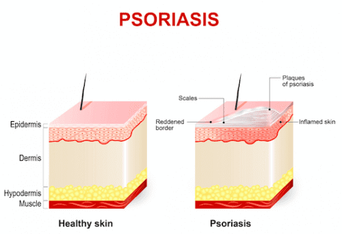 Psoriasis