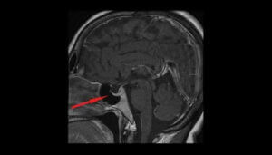 Hvad er hypofyseadenom for en type svulst?