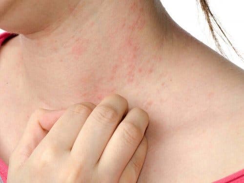Kvinde med atopisk dermatitis har udslæt på halsen
