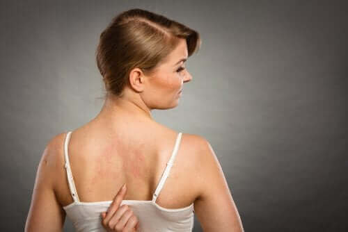 Kvinde har udslæt på ryg grundet allergi overfor tilsætningsstoffer til fødevarer