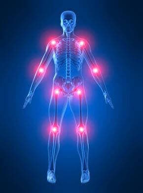 Illustration af led og knogler i kroppen viser pagets sygdom