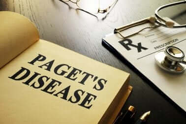Pagets sygdom - Alt, hvad du bør vide