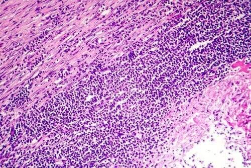 Nærbillede af hjerte illustrerer pericarditis