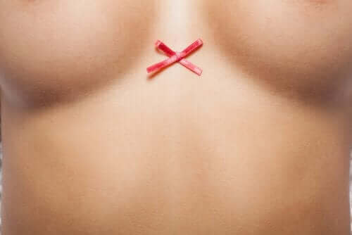 Kvinde med brystkræft har cancersløjfe mellem brysterne