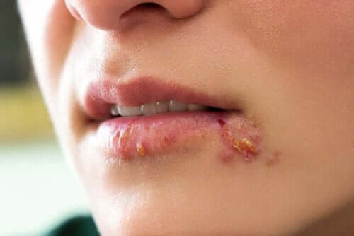 Herpes simplex 1