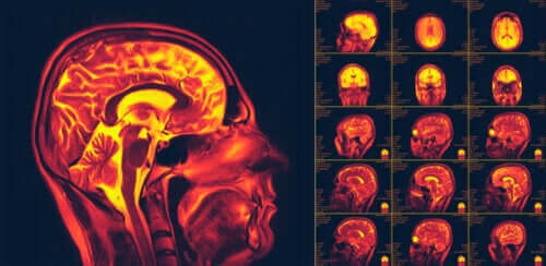 Hvad er neuroplasticitet i hjernen?