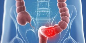 Hvad er en kolostomi?