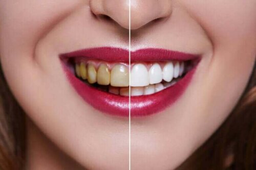 Kvinde med delvis hvide og delvis gule tænder