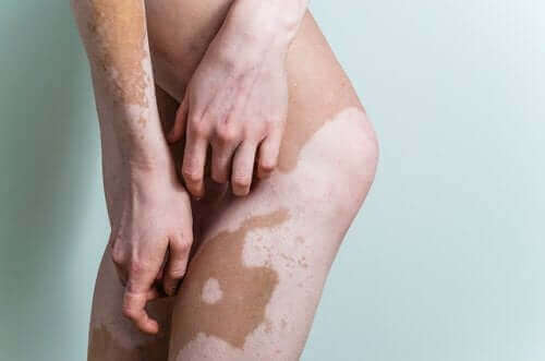 Korrigerende makeup kan anvendes ved tilfælde af vitiligo