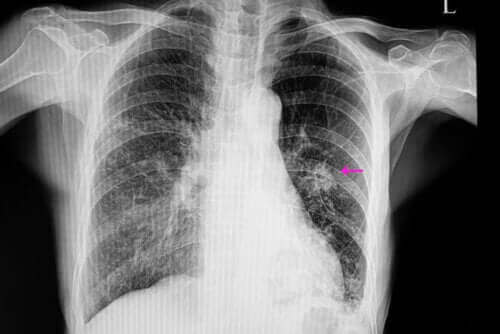 Hvad er en knude i lungerne helt præcis?