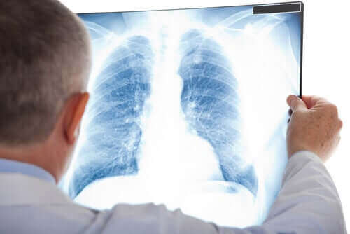 Læge tjekker røntgen for knude i lungerne