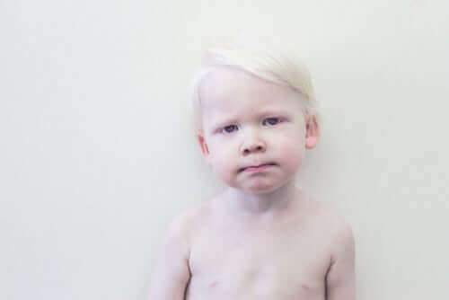 Albino dreng