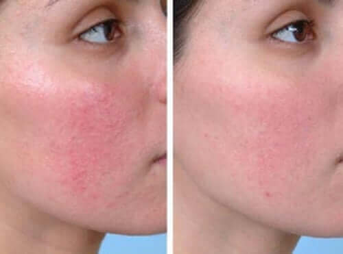 Kvinde illustrerer resultatet af behandling af rosacea