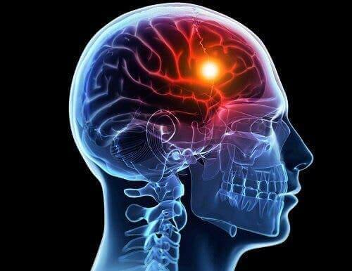 Illustration af emboli i hjernen