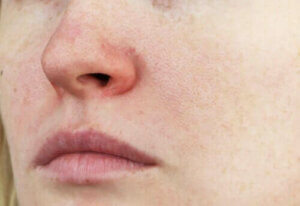 Rosacea: Karaktertræk og behandling