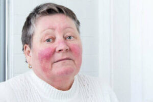 Årsager og symptomer på rosacea