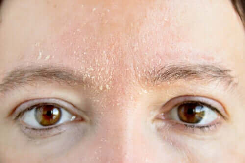 Kvinde med tør hud i ansigtet