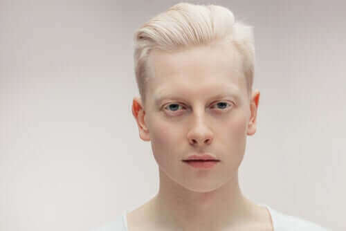 Lær alt, hvad du bør vide om albinisme