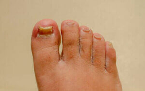 Virker midler mod neglesvamp på hænder og fødder?