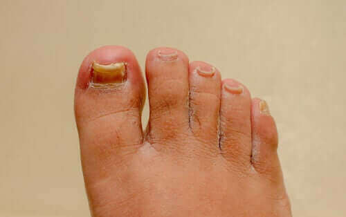 Virker midler mod neglesvamp på hænder og fødder?