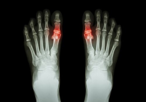 Scanning af urinsyregigt
