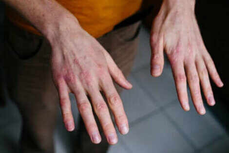 Smag Termisk skræmmende Tørre sprukne hænder: Beskyttelse mod kulden - Bedre Livsstil