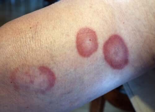 Granuloma annulare på arm