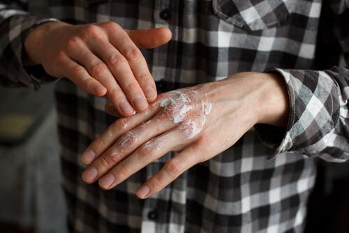 Person påfører topiske kortikosteroider på hænderne
