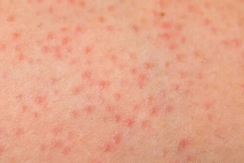 Nærbillede af keratosis pilaris