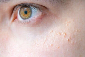 Keratosis Pilaris og naturlige midler