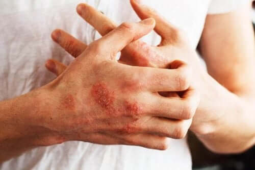 Du kan bruge sarsaparilrod som et hjælpestof til behandling af psoriasis