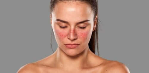Lupus har et karakteristisk symptom på huden i ansigtet, formet som sommerfuglvinger