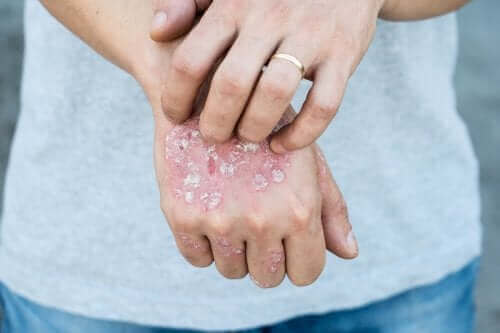Person ønsker at kunne kontrollere psoriasis