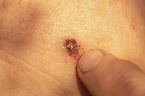 Eksempel på, at vorter bløder