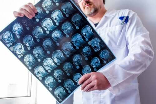 Scanninger af hjerne kan vise forskellige typer af epilepsi