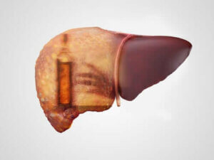 Alkoholisk hepatitis: Symptomer, årsager og behandling