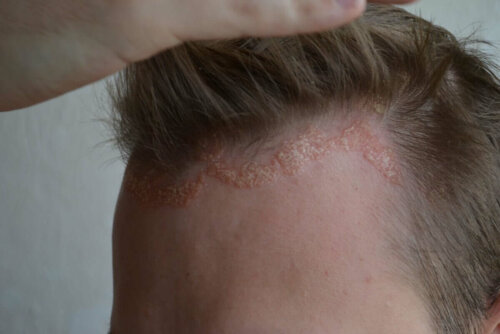 Mand med psoriasis ved hårgrænse