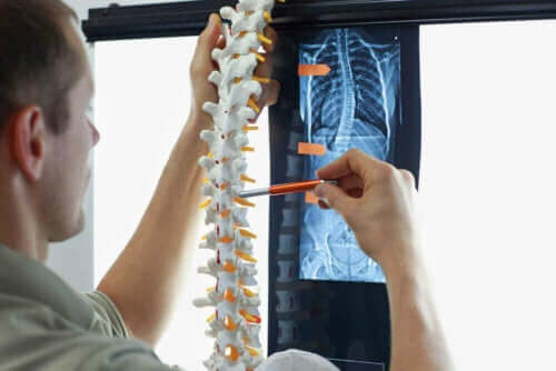 Læge illustrerer skoliose hos børn på model af rygrad