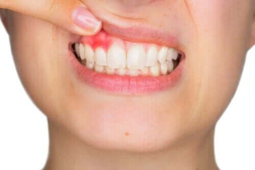 Tandkødsbetændelse kan behandles med hyaluronsyre