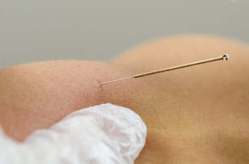 Behandling med tørre nåle - beskrivelse og fordele