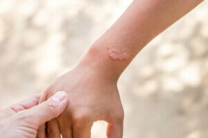 Hvad er ektoparasitter? Alt om mider og lopper