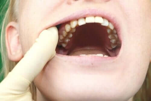 Person med åbe mund viser bakterier, som kan forårsage huller i tænderne