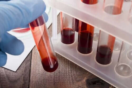 Blodprøver til at tjekke for hæmofili hos kvinder