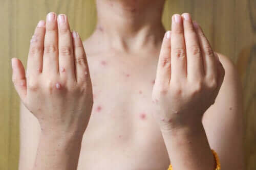 Symptomer og behandling af herpes zoster hos børn