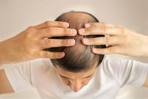 Skaldet mand kan få os til at stille spørgsmålet, om man kan tabe håret på grund af keto-kuren