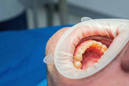 Mand med åben mund ved tandlæge