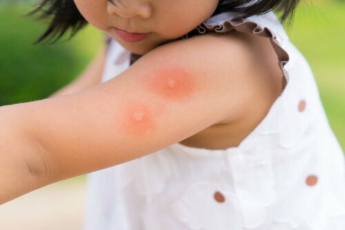 Barn med myggestik på armen