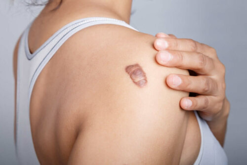 Kvinde med stort modermærke kan nyde godt af de forskellige effekter af resveratrol