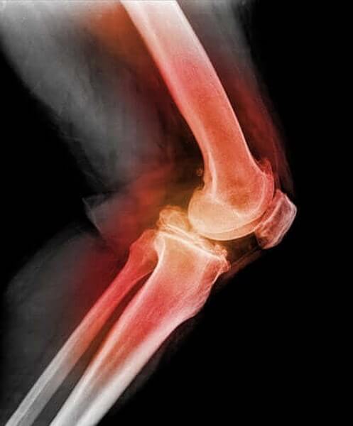 Knæskallen går af led