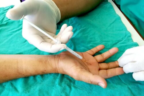 Indsprøjtning af steroider i behandling af springfinger